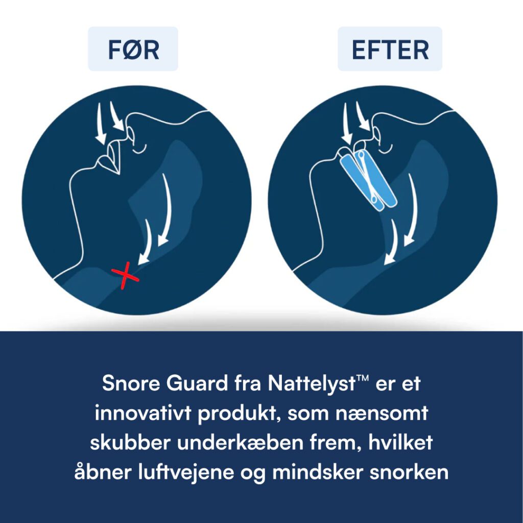 Før-og-efter illustrationen viser Snore Guard skubber underkæben frem og åbner luftvejene for at reducere snorken
