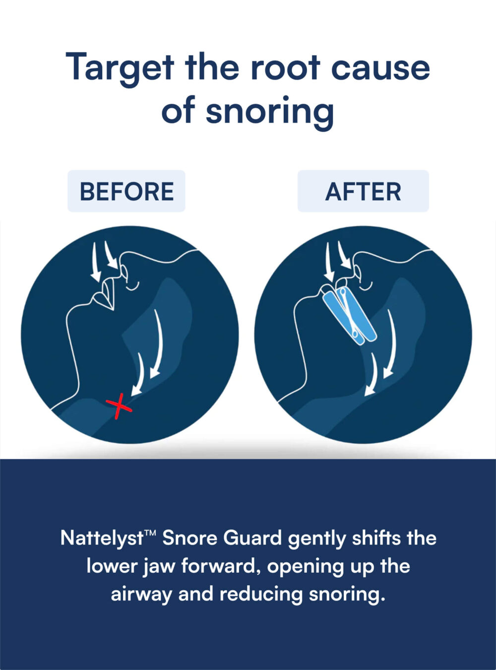Snore Guard (Anti-Snoring Mouthguard)